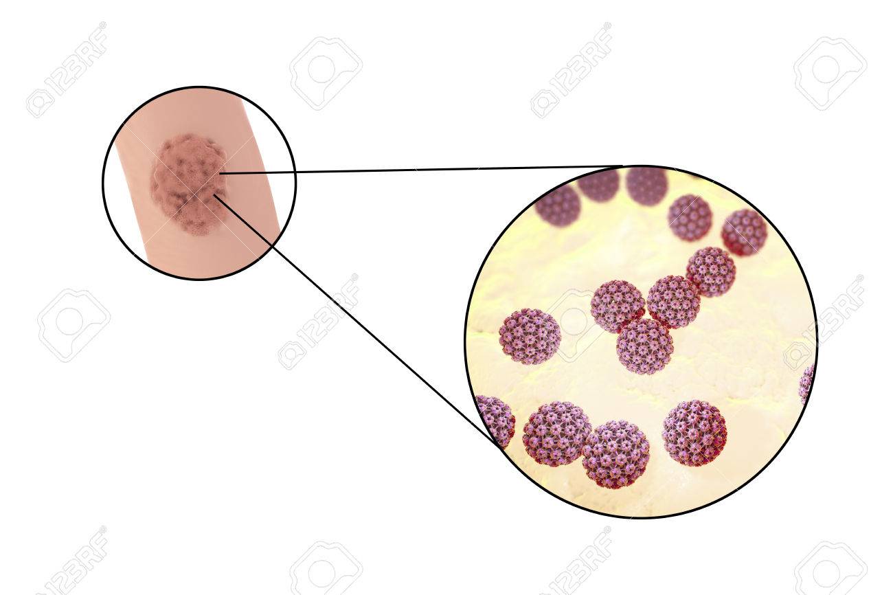 Papilloma virus